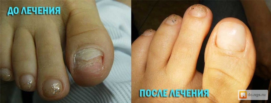 Деформация ногтя на большом пальце ноги лечение в домашних условиях Деформация ногтя на большом пальце ноги лечение в домашних условиях